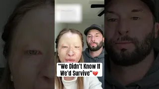 This Couple Survived A Fire Shorts BurnSurvivors Burnrecovery 