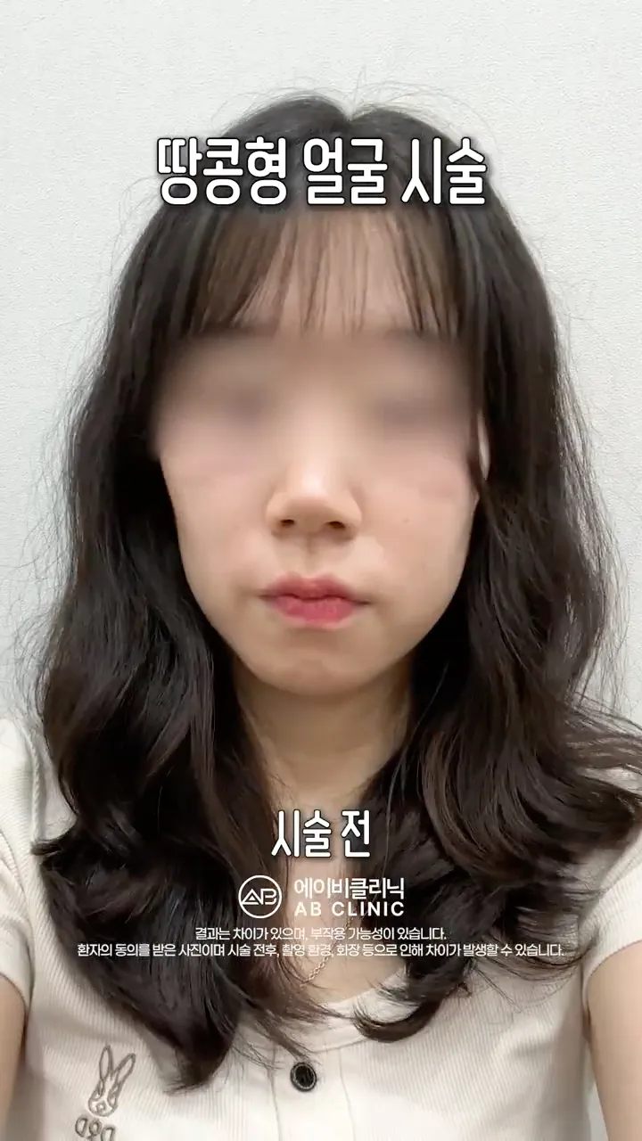 쥬베룩볼륨으로 얼굴 라인 극복