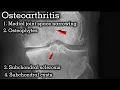 X-ray Knees in Osteoarthritis OSPE Guide