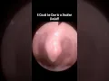 Download Lagu Swollen Uvula Causing Lump Sensation in Throat #shorts #throatlump #globus  @fauquierent