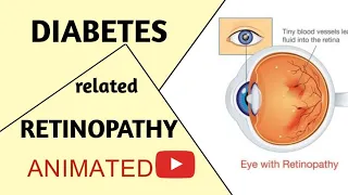 Diabetes related Retinopathy in Easy | Chemical Pathology | Animated