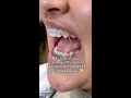 Can Orthodontists Tell If You re Lying About Wearing Rubber Bands