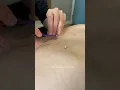 Japanese Moxibustion for shoulder knots