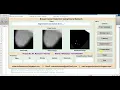 Breast Cancer Detection Using Neural Network
