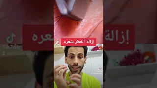 ازالة اخطر شعره تحت الجلد Entfernen Der Gefährlichsten Haare Unter Der Haut علاء خلف المانيا 