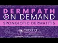 Spongiotic Dermatitis