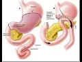 Gastrojejunostomy CPT code - simplify medical coding