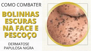 Como combater bolinhas escuras na face e pescoço (dermatose papulosa nigra)