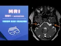 Download Lagu MRI – DWI – INNER EAR IMAGING