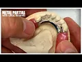 FULL PROCESS How to Make a Metal Partial with Attachments