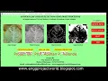 Soybean Leaf Disease Detection Using Image Processing Python Project With Source Code