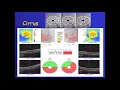 how to read an OCT report of glaucoma