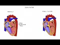 Understanding Arrhythmias