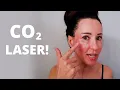 CO2 Fractional Ablative Laser Before After Pain Levels Recovery Dr Bartos Dermatology