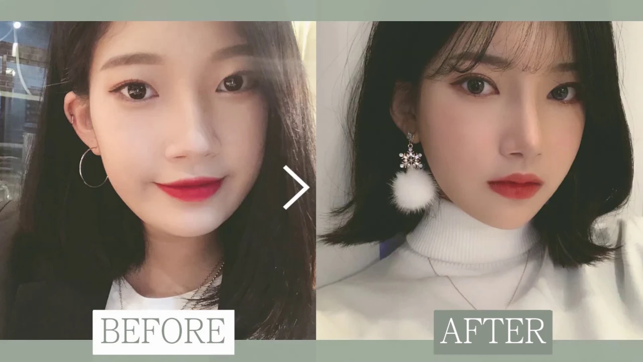 안면윤곽 3종수술 비포&에프터 - 수술 전후 영상 솔직 인터뷰