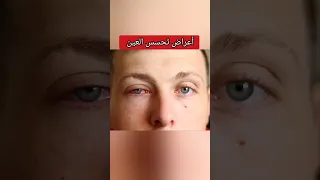احذر من هذه الأعراض قد تدل على تحسس العين دندنها