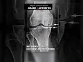 Download Lagu Knee Arthritis: Mild to Severe to NEW #shorts
