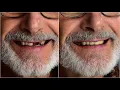 Temporary Missing Teeth Replacement