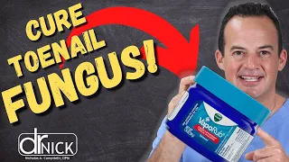 WILL VICK S VAPORUB KILL TOENAIL FUNGUS 