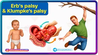 Erb s and klumpke s Paralysis Anatomy Animation Brachial Plexus injuries