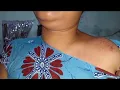 Kerokan Leher Pundak Masuk Angin Dan Leher Agak Serak