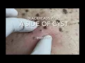 Blackheads with a side of cyst Blackhead extractions and cyst excision with closure Cyst dissection
