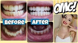 How I Got My Teeth STRAIGHT! | Price, Experience, etc!