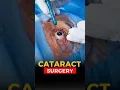 Download Lagu Live Cataract Surgery