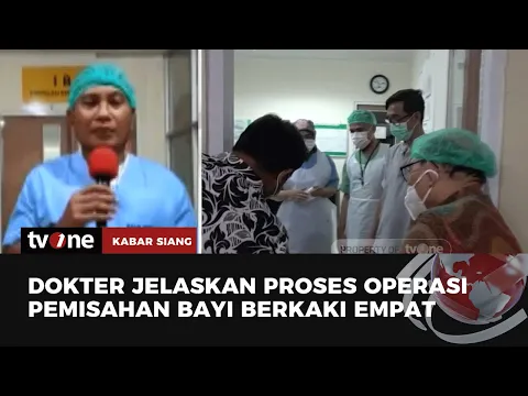 Bayi Kembar Siam Berkaki Empat asal Lombok Timur Jalani Operasi Pemisahan Hari Ini