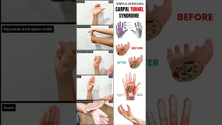 5 Easy Exercises for Carpal Tunnel Relief Physiotherapist-Approved