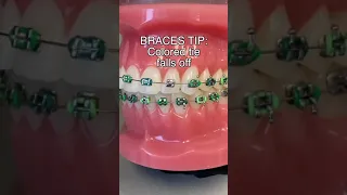 Braces Tie Falls Off Here s What To Do