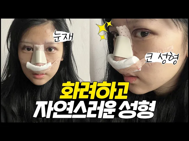 [VLOG] 화려한데 자연스러운 코 원합니다 😝 소시지 눈 없애기 위한 눈 재수술 + 코 성형 😳
