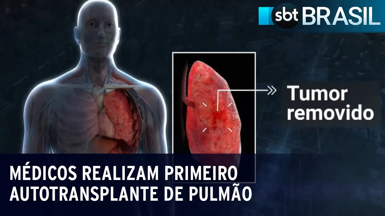 Médicos realizam primeiro autotransplante de pulmão em São Paulo | SBT Brasil (18/07/23)