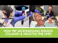 How Microneedling with PRP Rebuilds Collagen Smooths Fine Lines 4Ever Young Katy