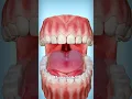 What Are Tonsil Stones