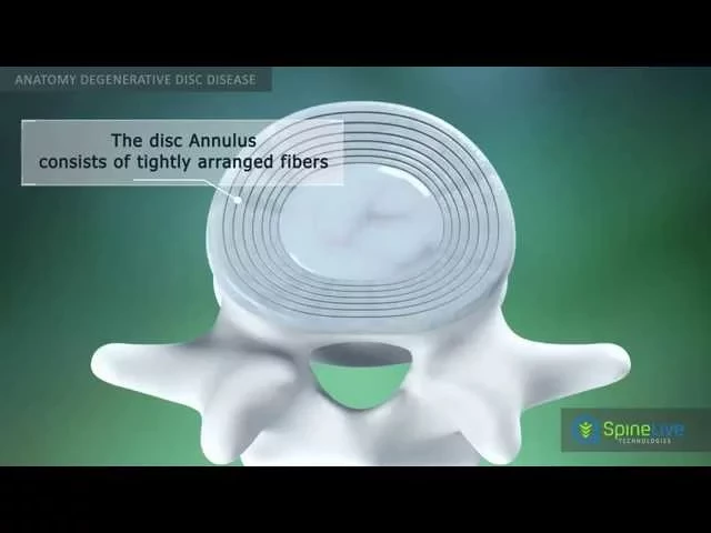 Degenerative Disc Disease Anatomy