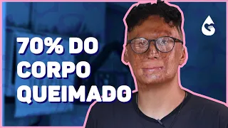AOS 3 ANOS DE IDADE ELE TEVE 70% DO CORPO QUEIMADO | Histórias de ter.a.pia