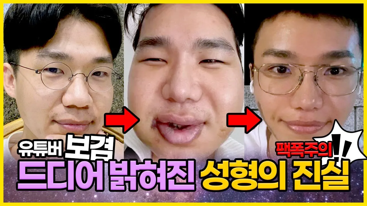 300만 유튜버 보겸 성형 전후 분석 (feat 보겸 성형외과)