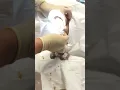 Exploding grapefruit sized sebaceous cyst popping