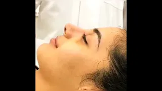 نتيجه مباشراعملية تجميل انف بعد فتح القالب 