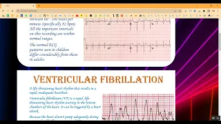 Heart disease Classification using CNN Train Image in Python Projects
