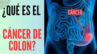 What is colon cancer?