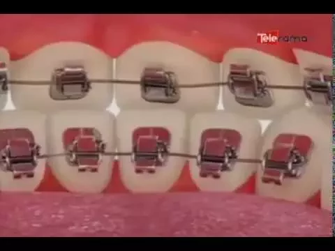 Ortodoncia Lingual Brackets invisibles