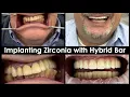 Implanting Full-Mouth Zirconia with Hybrid Bar in Patient s Mouth