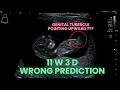 Ultrasound Pregnancy Wrong Gender prediction WHY