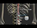 Experimental device helping paralyzed patients walk again
