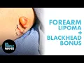 Dr Lee s Lipoma Extraction Comes With A Blackhead Bonus Dr Pimple Popper