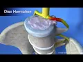 How does Spinal Decompression work - Health First Group