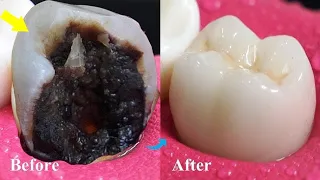 Incredible Restoration Of Tooth By Root Canal And Zirconia Crown.Hardest Tooth To Restore #C63 #4k