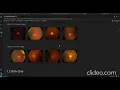 Glaucoma Detection Using Machine Learning and Fundus Imaging